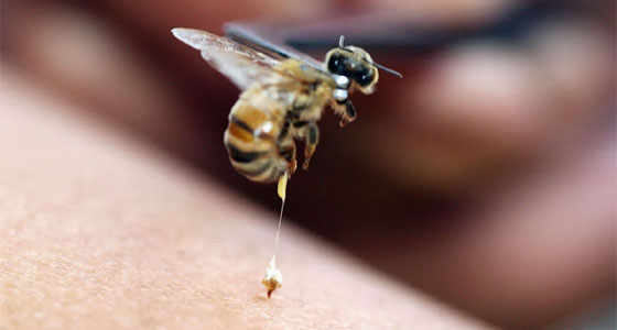العلاج بالإبر الصينية.. وسم النحل!!