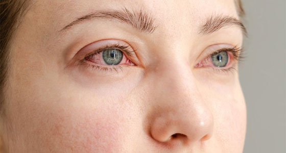 الفرق بين الرمد وحساسية العين